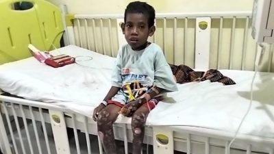 Derita Bocah Gizi Buruk di SBT: Kakinya Lumpuh, Hb Rendah dan Infeksi Jaringan